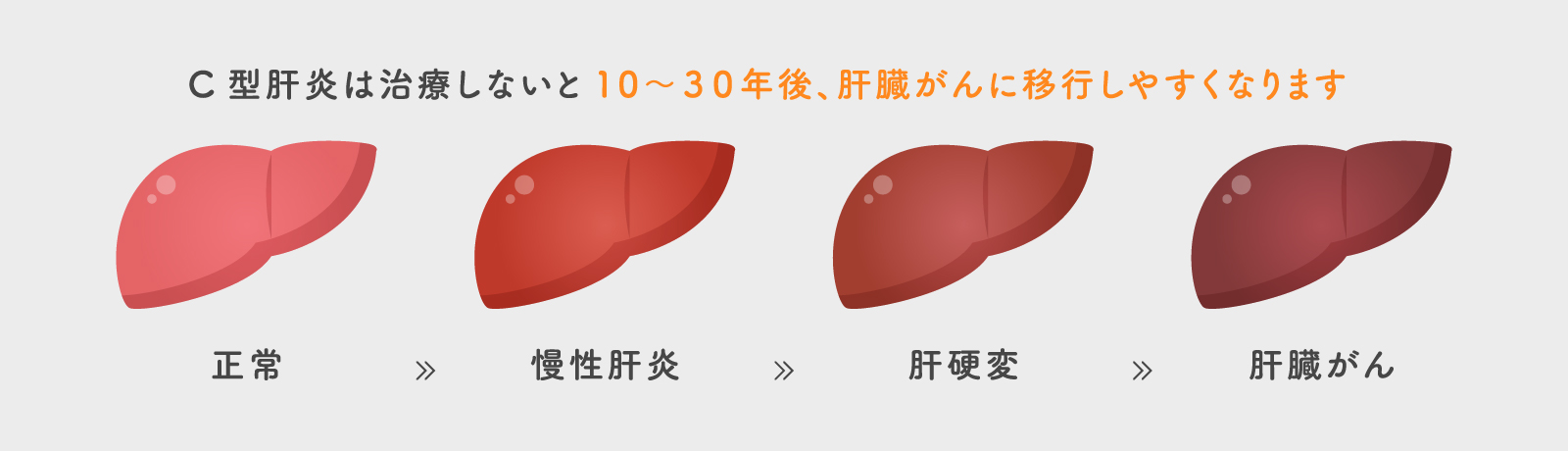 C型肝炎は治療しないと10〜３０年後、肝臓がんに移行しやすくなります